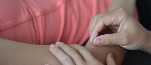 dry needling